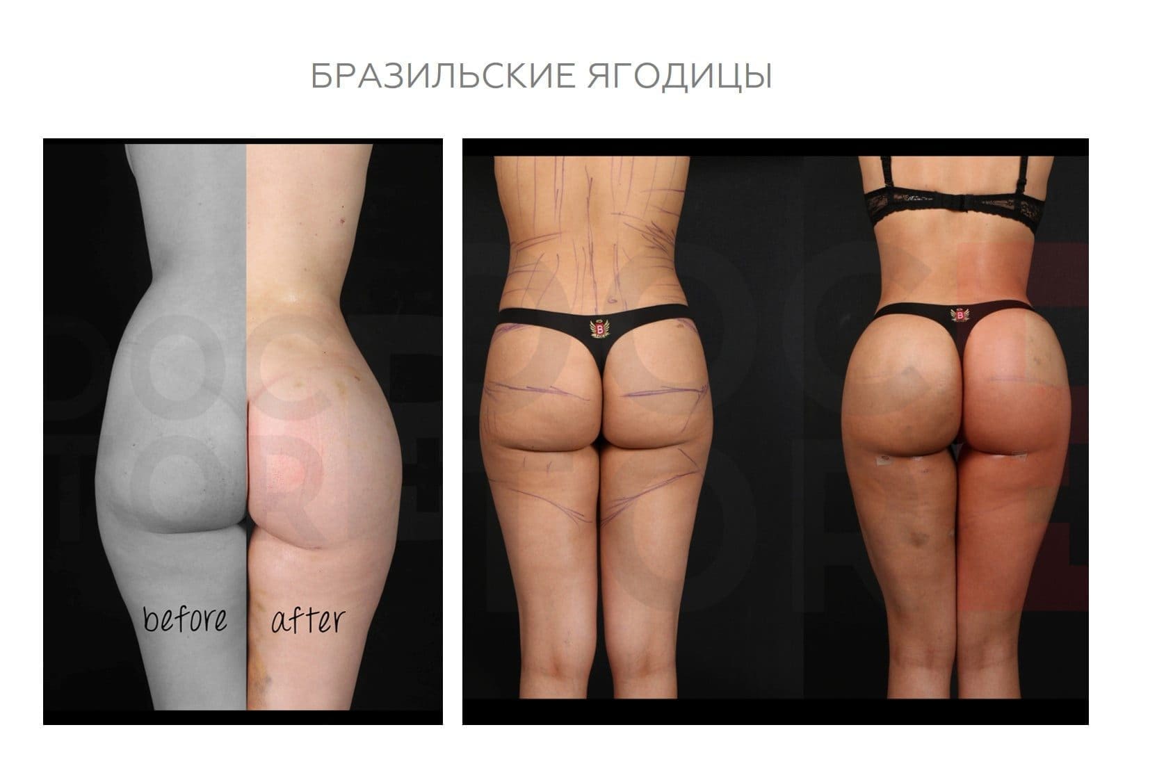 Бразильские ягодицы