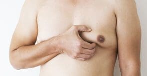 Gynecomastia