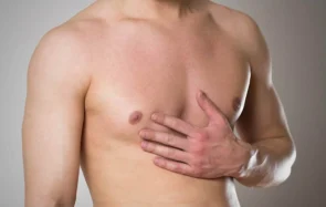 Gynecomastia