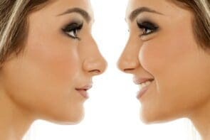 Rhinoplasty: who is suitable for nose shape correction and how to get the perfect result?
