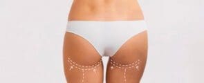 Buttock augmentation