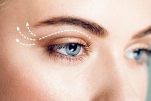 Eyelid lift
