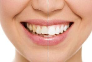 Veneers installation in Turkey