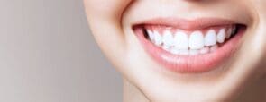 Emax Veneers