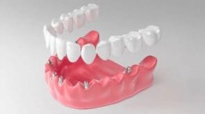 All-on-4 vs All-on-6: How to choose the ideal prosthetic option?