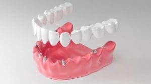 All-on-4 vs All-on-6: How to choose the ideal prosthetic option?