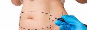 Is Abdominoplasty Effective for Weight Loss?