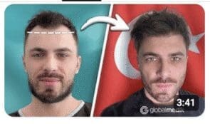 Пересадка волосся у Туреччині з Hair.Globalmedik