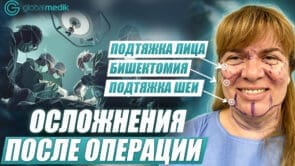 SMAS подтяжка лица в 50 лет: личный опыт Марины 
