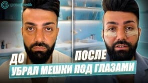   Мужская блефаропластика в Турции