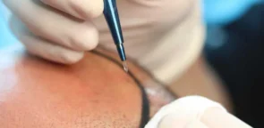 Manual Graft Extraction Method (Manual Hair Extraction): A Revolution in Hair Transplantation