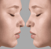 Secondary Rhinoplasty: When Is It Worth Redoing Your Nose?